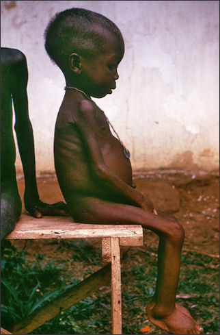 20120514-Biafra-Starved_girl.jpg