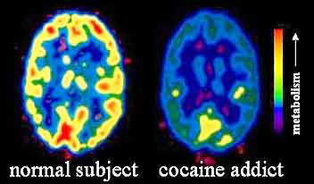 20120528-cocainePET_image_-_cocaine_addict.jpg